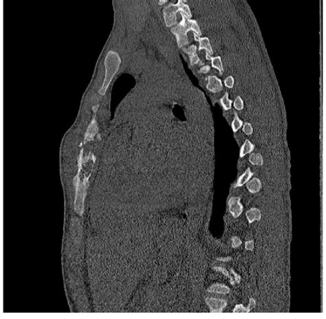 Computed Tomography Scan Showing An Osteomyelitis Of The Sternal Body