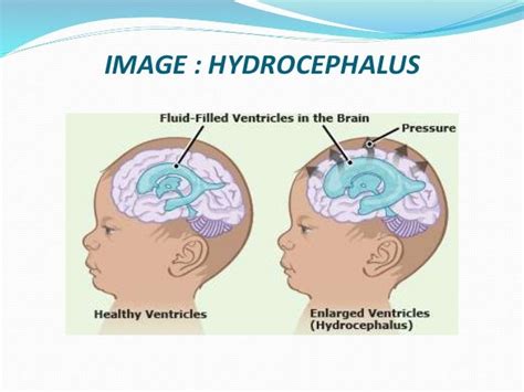 Hydrocephalus Treatment