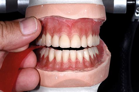 Case Report An Efficient Full Denture Teamcombining The Aesthetic And