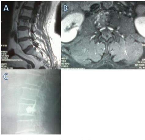 Figure 2 From INTERET DE LA VERTEBROPLASTIE ET LA KYPHOPLASTIE DANS LA