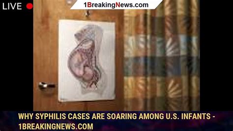 Why Syphilis Cases Are Soaring Among Us Infants