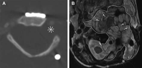 Plexiform Neurofibroma In A Patient With Neurofibromatosis Type