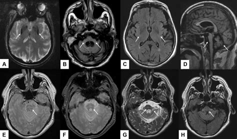 Mri Features Observed In Msa Putaminal Hypointensity A Atrophy Of Download Scientific