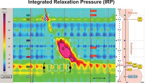 A Primer Of High Resolution Esophageal Manometry Seminars In Thoracic