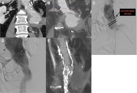 Ruptured Juxtarenal Abdominal Aortic Aneurysm Managed With Endosuture