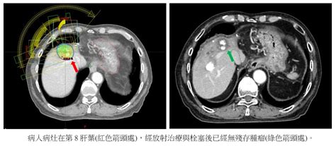 圖：肝癌治療前後對照圖。