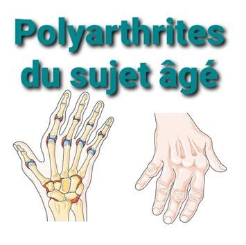 Polyarthrites du sujet âgé Santé Médecine