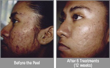 Post Inflammatory Hyperpigmentation – Pictures, Treatment, Causes