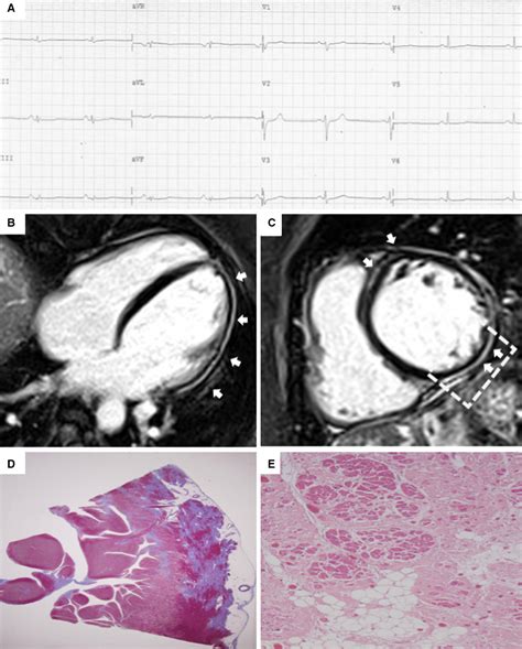 Arrhythmogenic Right Ventricular Cardiomyopathy Characterization Of