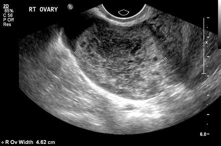 Ovarian Torsion Detorsion Radiology Case Radiopaedia Org