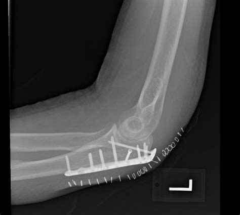 olecranon fracture post-op - JR Rudzki, MD