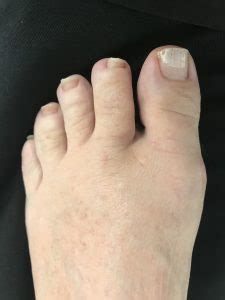 Bunion Surgery Before And After Photos Northwest Surgery Center