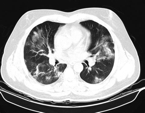 Chest Ct Scan Revealed Multifocal Peribronchial Ground‐glass Opacities