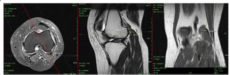 The left knee MRI showed a joint intruded fabella with tear of lateral ...