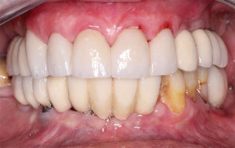 Casos Reales Cl Nica Dental La Casilla