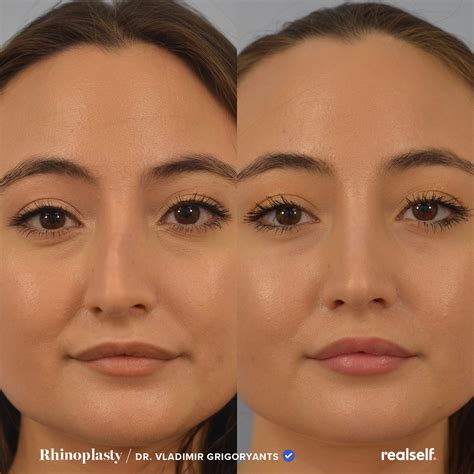 Rhinoplasty The Ultimate Guide To A Nose Job Realself Nose Job