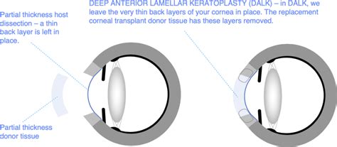 Benefits Of Cornea Transplant Surgery Ask The Nurse Expert