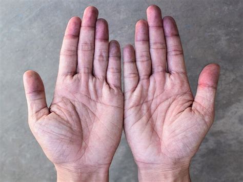 Cyanosis Types Symptoms Causes Treatment More Off