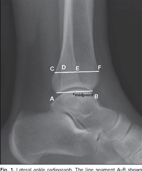 Pdf Radiographic Evaluation Of The Ankle Syndesmosis Semantic Scholar