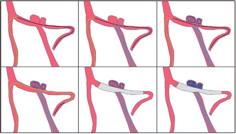 Treatment Method Schema A A Microcatheter For Stenting Is Guided