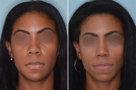 Ethnic Rhinoplasty Photos Miami Fl Patient 6495