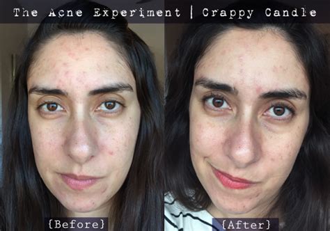 Caru Witch Hazel + Bee Balm Toner Review - The Acne Experiment | Crappy Candle