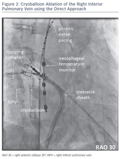 Figure Cryoballoon Ablation Of The Right Inferior Pulmonary Vein