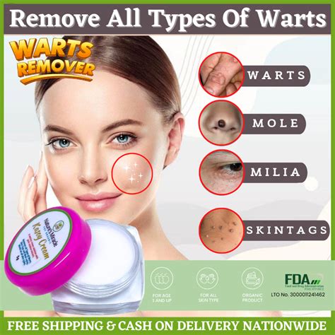 Kasoy Cream Warts Remover Warts Remover Original Kasoy Cream Wart