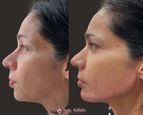 Jawline Fillers Before After Results At Skinly