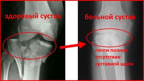 Гонартроз коленного сустава: причины возникновения, симптомы и степени ...