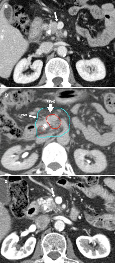 Pancreatic Protocol Ct Of The Abdomen Venous Phase Illustrating