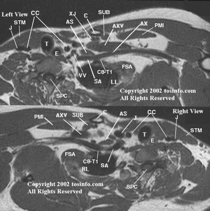 3D Brachial Plexus MRI/MRA/MRV: 3D MRI, Transverse Oblique Sequence