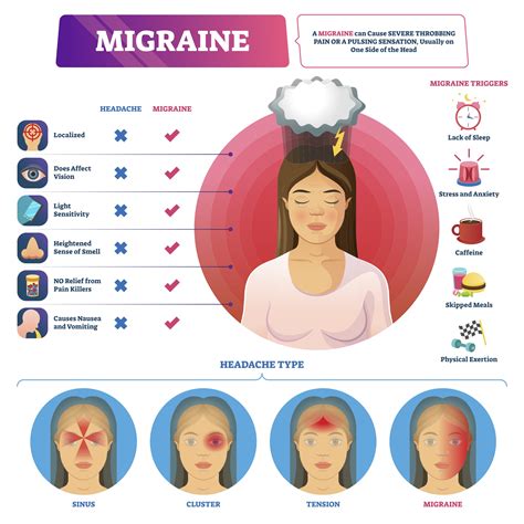 Migraine - AppLocum : AppLocum