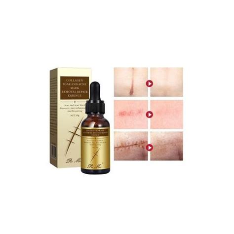 Pei Mei Collagen Scar And Acne Mark Removal Repair Essence Best Price