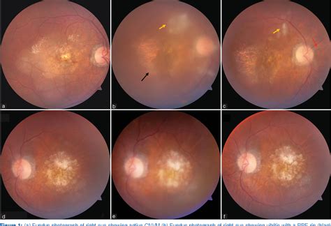 Figure From Retinal Pigment Epithelium Rip With Posterior Uveitis