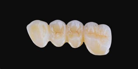 porcelain fused  metal hex dental lab