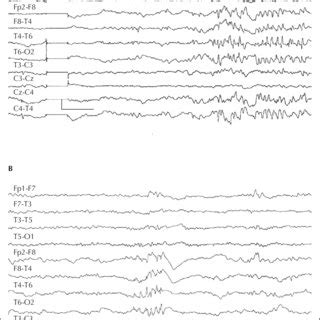 Pdf Epileptic Nystagmus