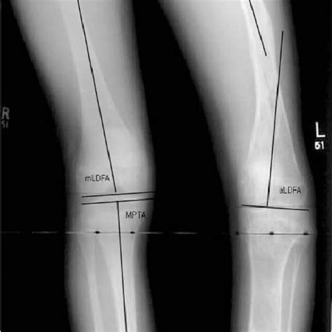 Long Leg Standing Ap Radiograph Illustrating Normative Joint Download Scientific Diagram