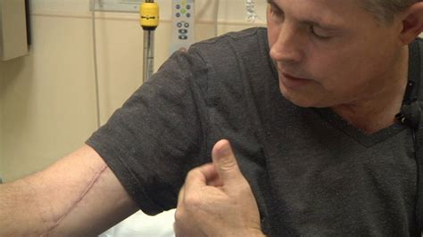 Clay County Man Survives Flesh Eating Bacteria