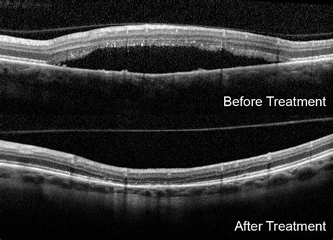 Central Serous Chorioretinopathy Treatment - New York Retina Specialists