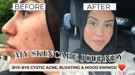 My Skincare Journey Pcos Cystic Acne Gut Health And Healing My Inner