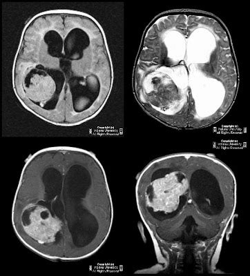 Neuroradiology On the Net: Choroid plexus papilloma