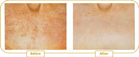 Skin discoloration treatment - MédIME, institut de médecine esthétique ...