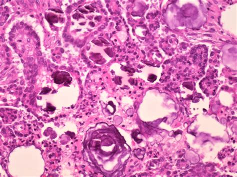 Pathology Outlines Calcification