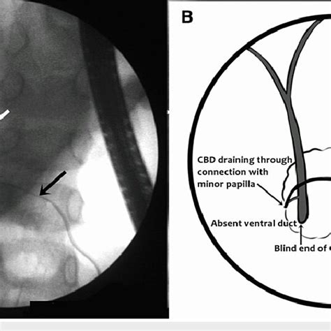 A Cholangiogram Image Showing Absent Ventral Duct Bile Duct Large