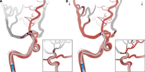 Optimization Of Endovascular Therapy In The Neuroangiography Suite To