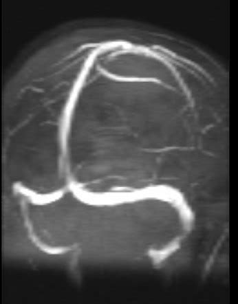 Unilateral Thalamic Infarction In Protein S Deficiency Image