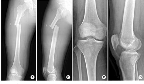 Figure From Avulsion Of The Femoral Attachment Of Anterior Cruciate