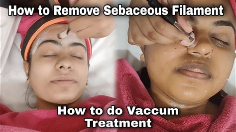 Get Rid Of Sebaceous Filaments How To Use Vaccum Treatment How To Remove Blackheads Youtube