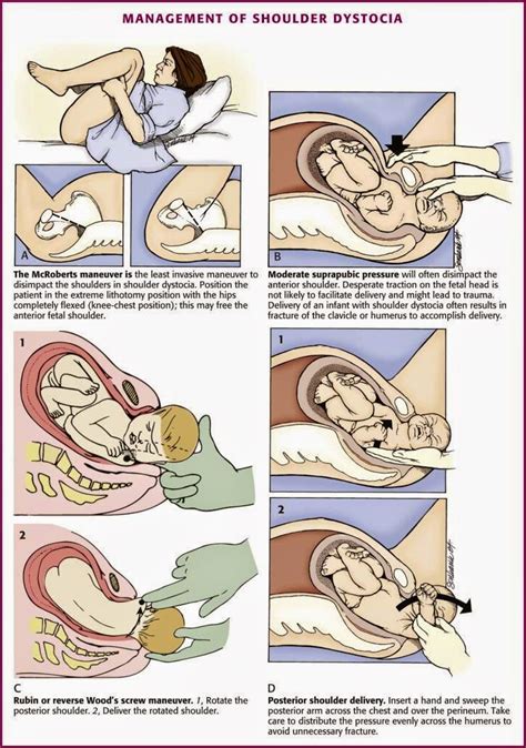 Management Of Shoulder Dystocia Emergency Medicine Kenya Foundation